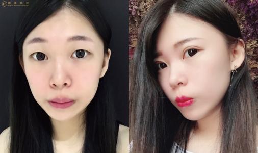 郑州做双眼皮的专家有哪些?哪个医生性价比高?