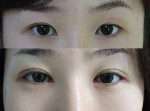 潘贰和王振军修复双眼皮谁厉害?