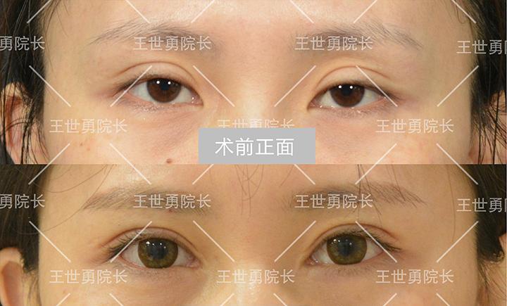 国内知名度较高双眼皮修复专家都有哪些?