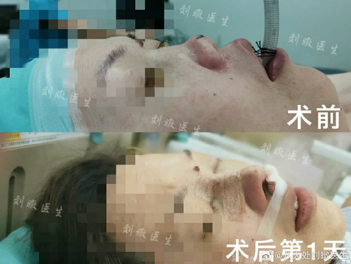 刘暾隆鼻案例