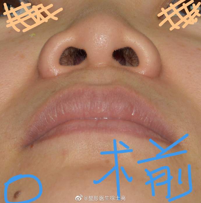 徐士亮隆鼻案例