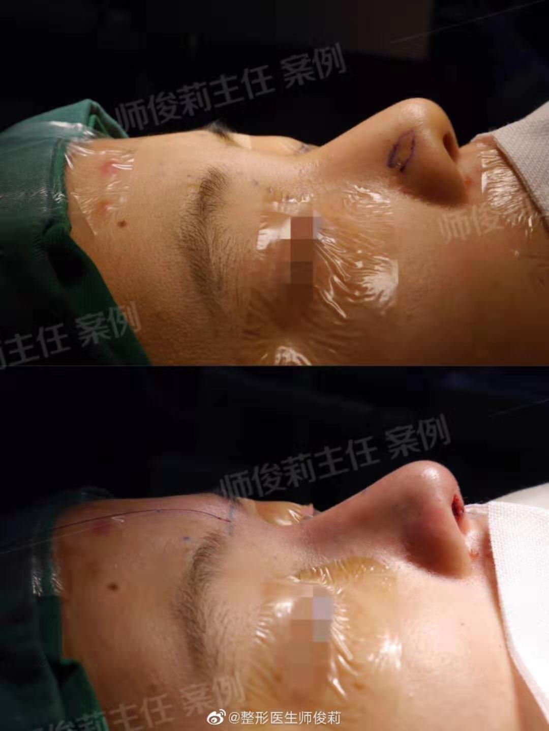 师俊莉鼻综合案例