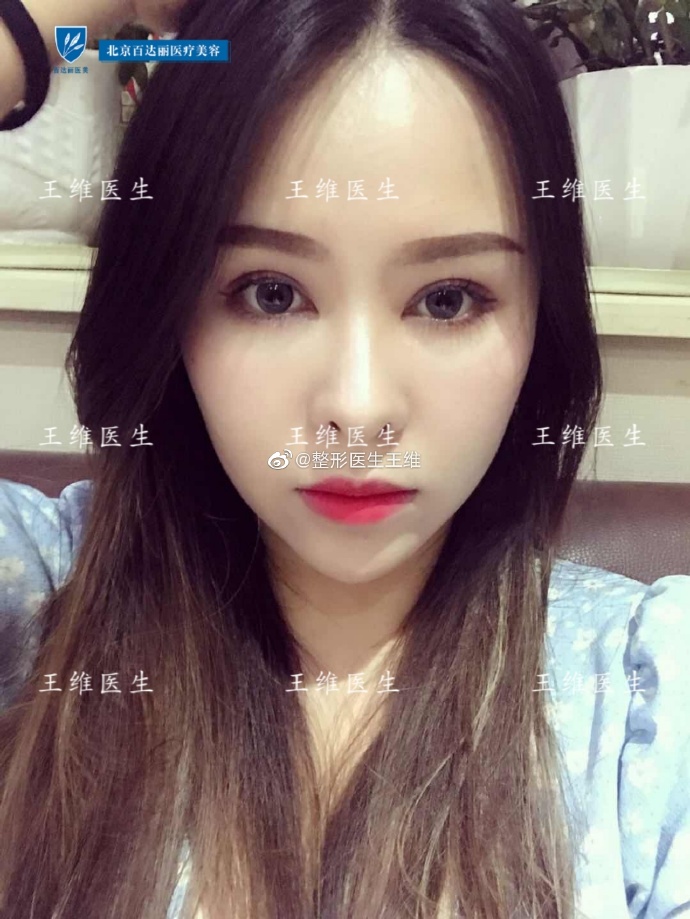 王维双眼皮修复案例