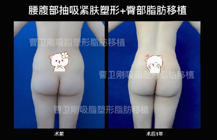 上海丰臀选哪家医院较好?李健和邱文苑哪个更好?