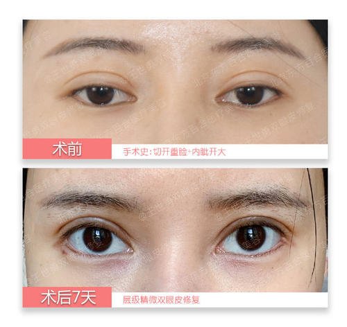 合肥双眼皮修复哪个医生专家做的好?