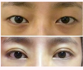 福州双眼皮做得最好的医生是谁?