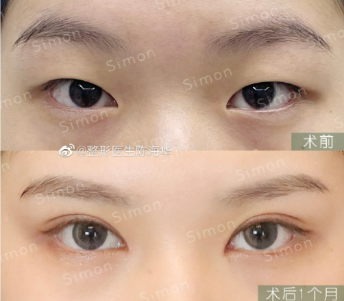 杭州陈海华做双眼皮技术怎么样?