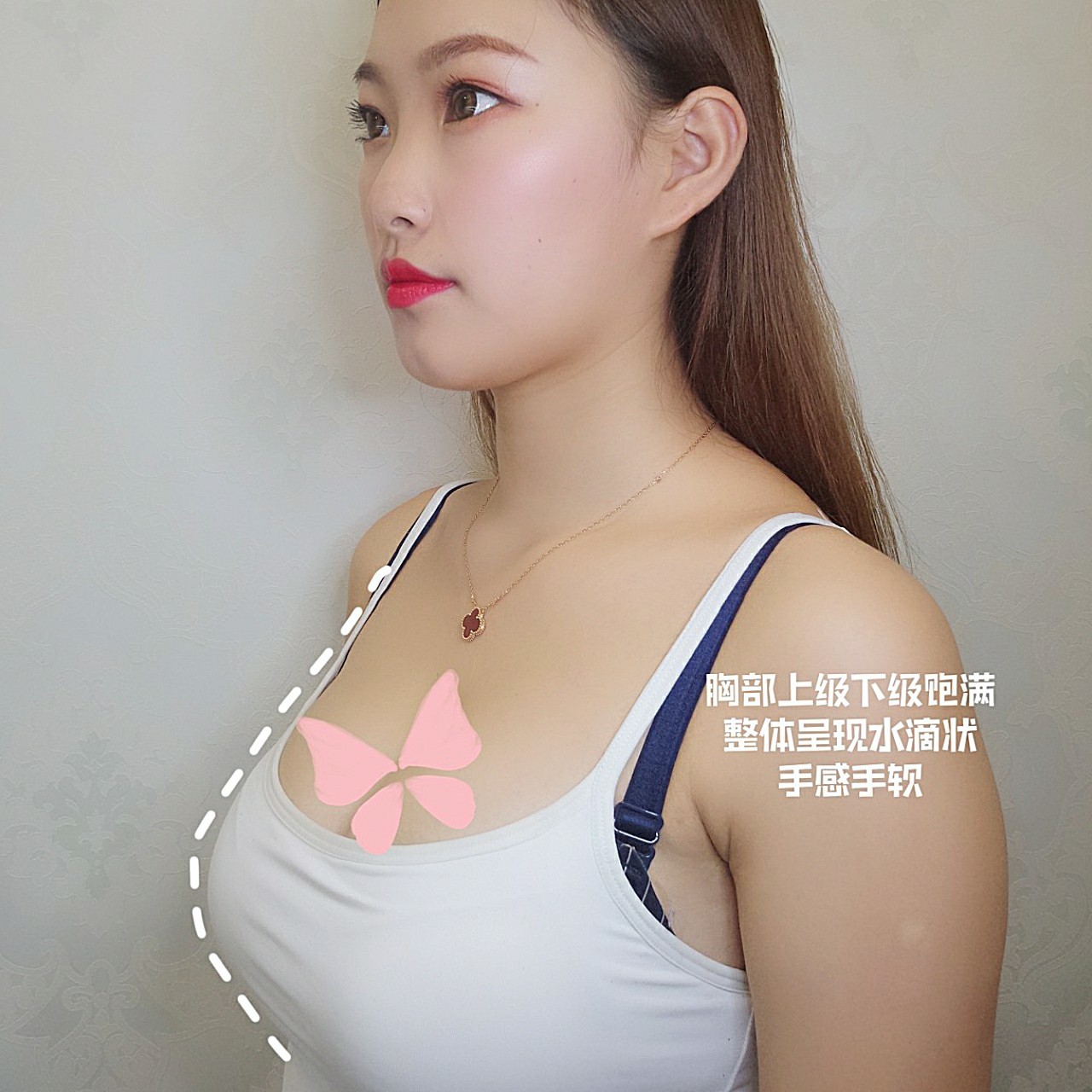 北京八大处栾杰做假体丰胸贵吗?