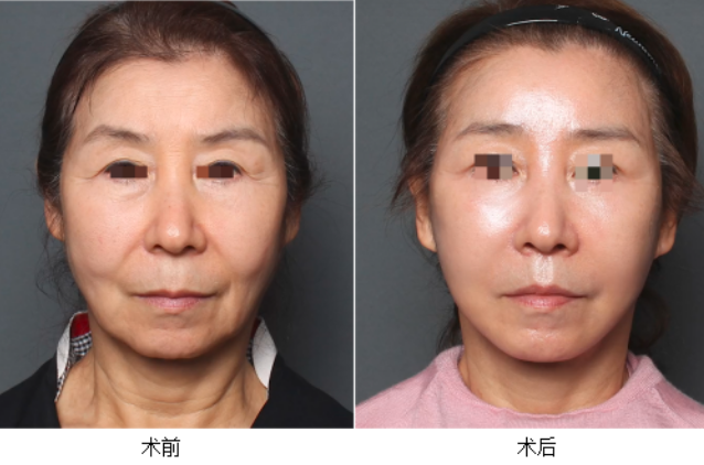 北京拉皮手术最好的医生是哪个?祝东升、赵延勇、张海明、谢宏彬?