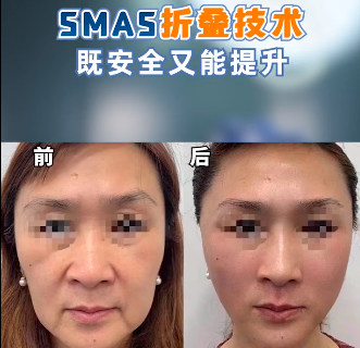 北京八大处谢洋春做拉皮手术怎么样?