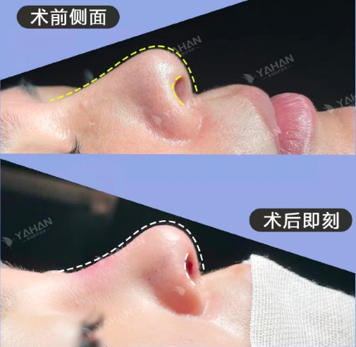 深圳鼻修复高山和李信峰哪个医生好?