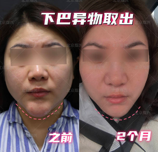 北京周云超取异物取出怎么样?技术好不好?能取干净吗?