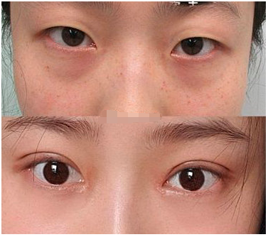 成都车红昌做双眼皮怎么样?