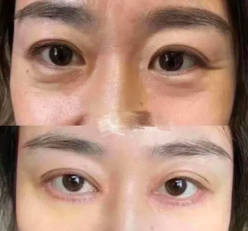 上海九院祛眼袋哪个医生好,高博闻、许志成、刘菲、金云波哪个最好