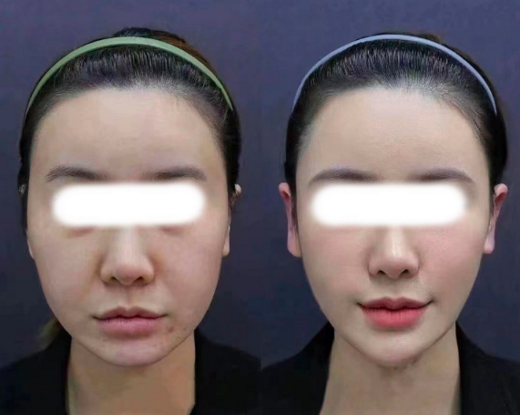 国内擅长做无痕筋膜提升的医生有哪些?