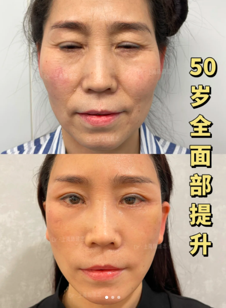 上海陈建忠做拉皮技术怎么样?