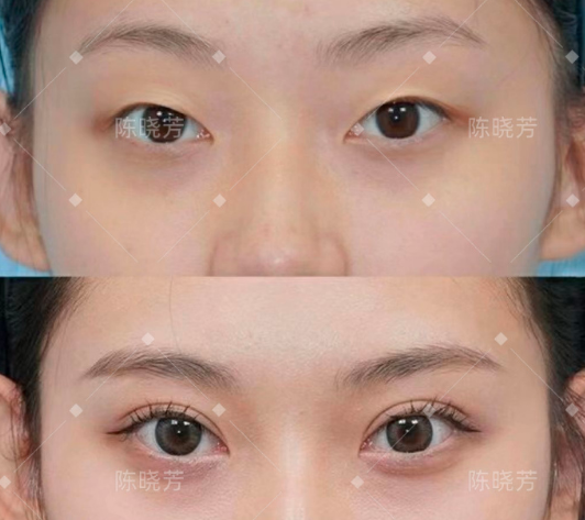 北京朝阳医院陈晓芳做双眼皮怎么样?