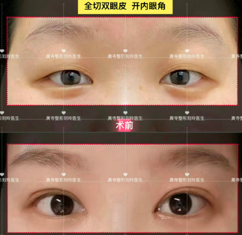 北京刘玲医生做双眼皮修复技术怎么样?
